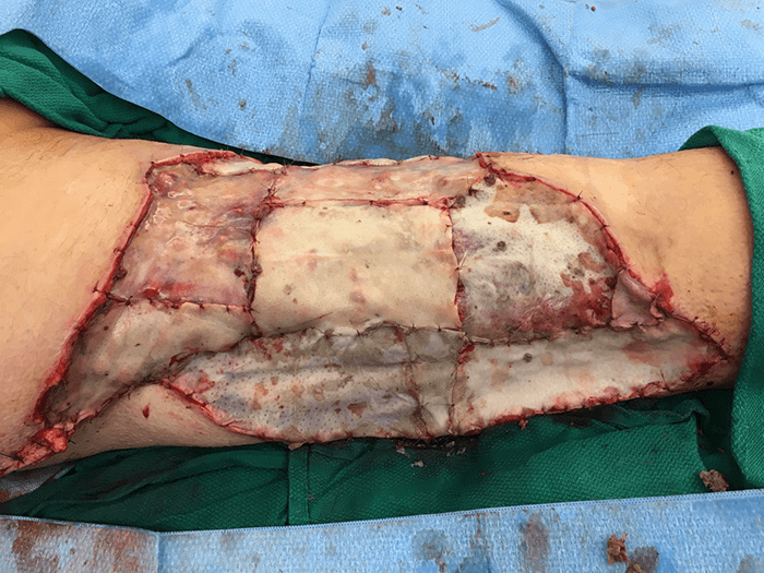 Figure 2. Post-operative leg wound following debridement and coverage with Gammagraft