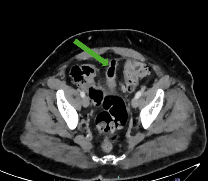 Axial CT scan of the pelvis. The image shows a gas-filled outpouching (green arrow) arising from the dome of the bladder and extending superiorly into the prevesicular extraperitoneal space, consistent with a urachal remnant