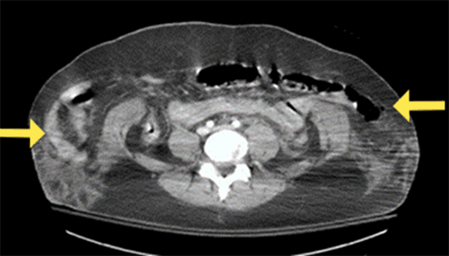  This image demonstrates herniation of viscera through the abdominal musculature with markedly lateral displacement into the subcutaneous space, as indicated by the yellow arrows