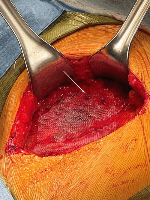 Wire sutures emanating from mesh anchors are used to secure the mesh to the superior aspect of the iliac crest