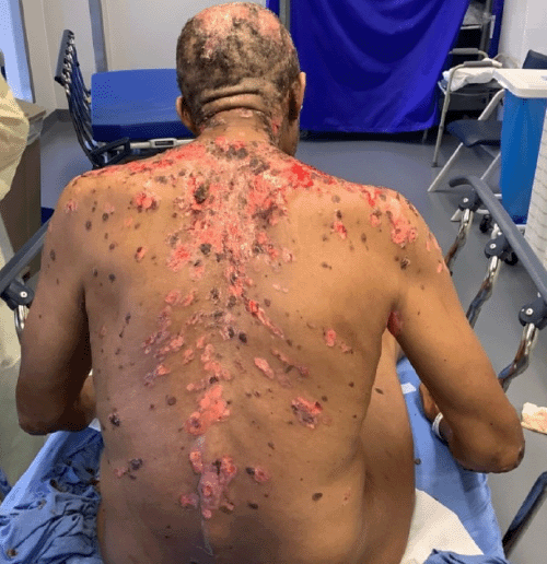Clinical photograph (posterior view) showing extensive partial-thickness erosions and bullous lesions across the back and shoulders, with diffuse scabbing and areas of desquamation, characteristic of severe pemphigus vulgaris