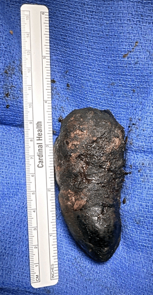 The specimen is an ovoid, calculus with a coarse texture, measuring approximately 9 cm in its longest dimension, consistent with the cause of the duodenal obstruction