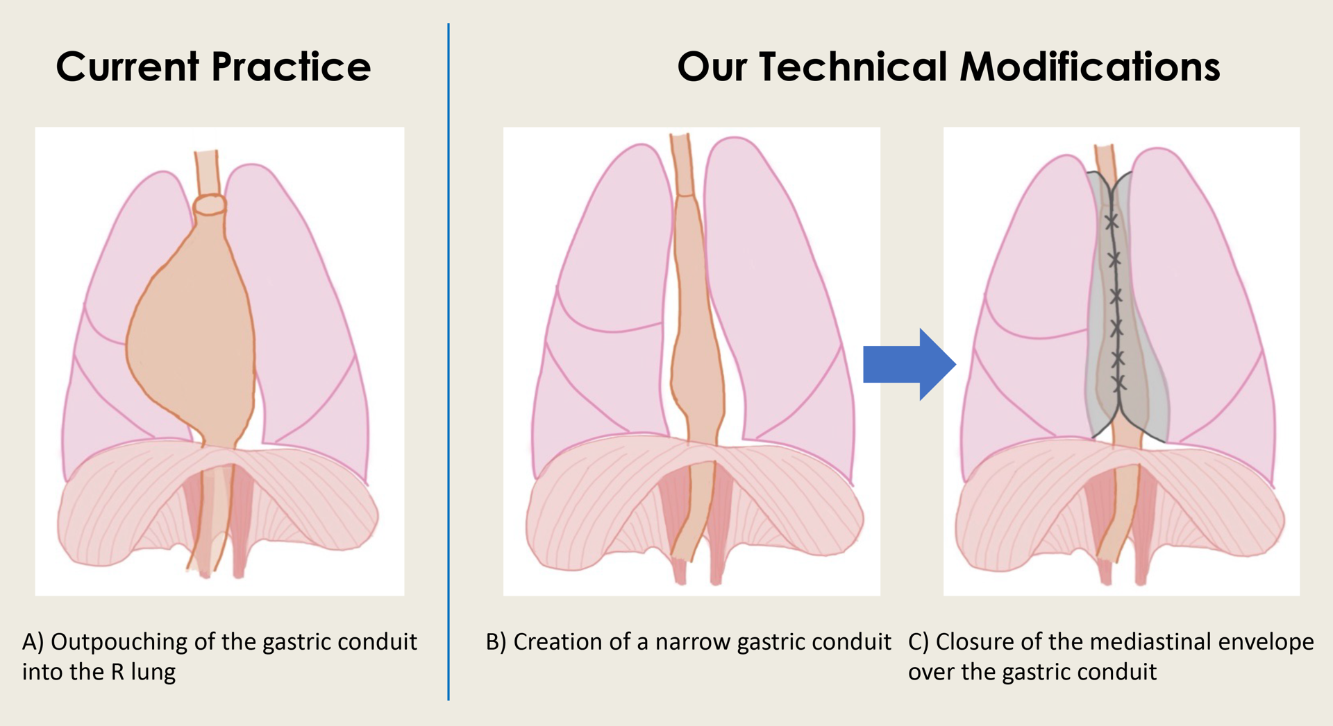 Figure 1: Our MIE modifications compared to current practice