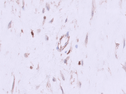 Demonstrating positive nuclear staining for beta-catenin in tumor cells