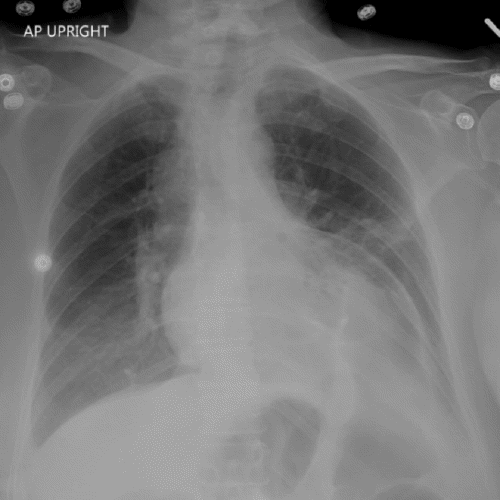 A) Large hernia from left anterior diaphragm, concerning for traumatic hernia