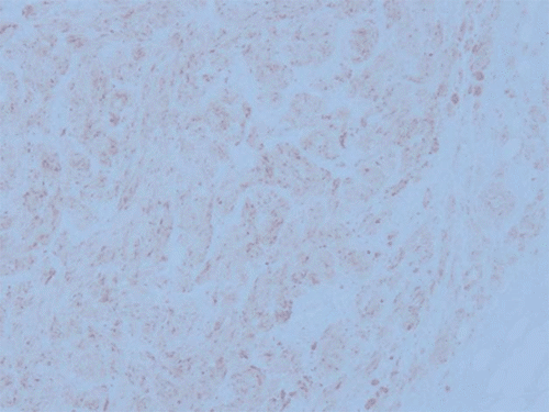 B. Histological findings of the tumor showing positive immunoreaction for CD-68