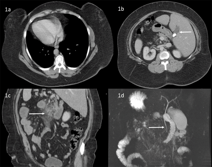 (A) Dextrocardia. (B) Liver and gallbladder (white arrow) located in the left upper quadrant. (C) Acute pancreatitis (white arrow). (D) Magnetic resonance cholangiopancreatography demonstrating no choledocholithiasis (white arrow)