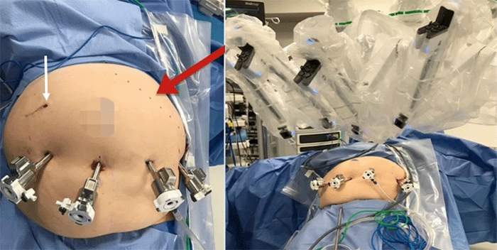 Right upper quadrant Veress needle insertion (white arrow); planned left subcostal incision line for potential open conversion (red arrow); robotic docking