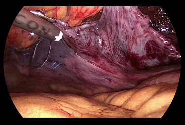 Figure 6. Mesh covered by peritoneum