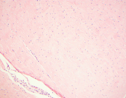 C) A medium power view demonstrates the bland nuclei associated with the lesion; note the lack of hyperchromasia or atypia