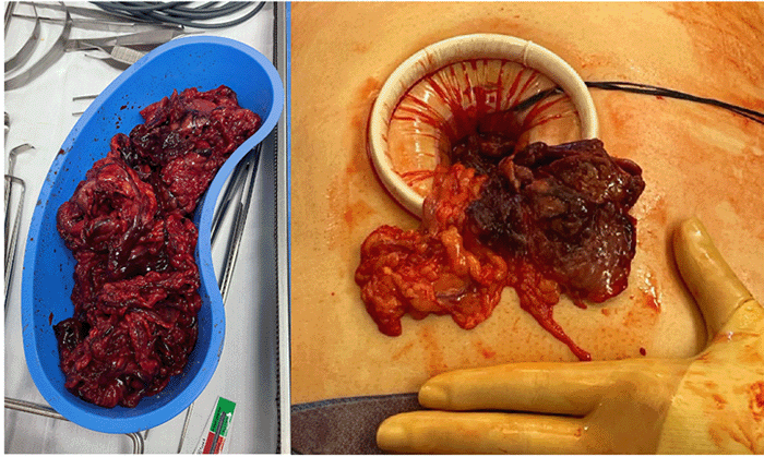 Infarcted omentum (left) and comparison of healthy and infarcted omentum (right)