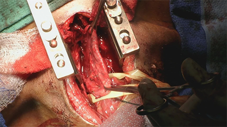 Figure 6. Intraoperative image showing the entire diverticulum after completion of dissection and myotomy.