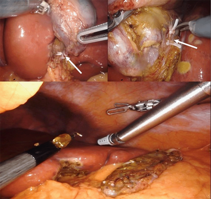 Cystic duct and cystic artery clipped and transected (white arrows); gallbladder removed from the cystic plate
