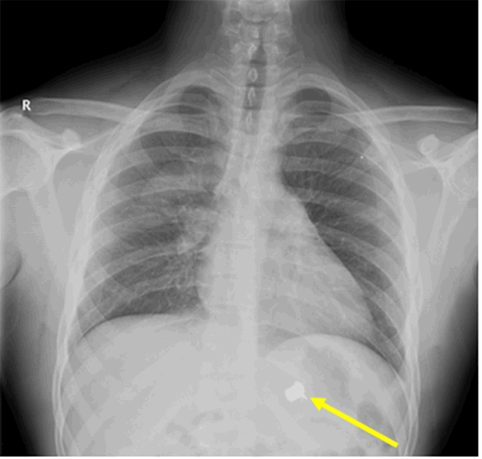 Figure 5. Follow-up chest X ray of patient with Transmediastinal gunshot wound. Solid yellow line indicates the position of the bullet on X ray.