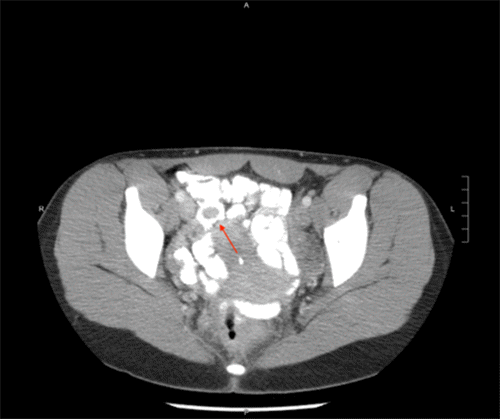 The Inverted Appendix Intussusception of the Appendix Secondary to Endometriosis | ACS