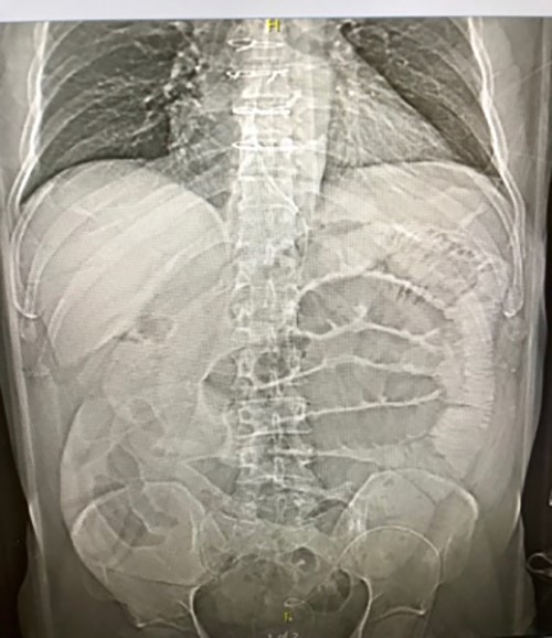 Figure 2. X ray showing dilated loops of bowel.