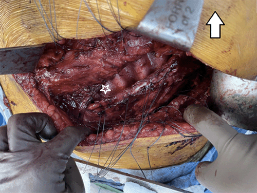 A) Placement of underlay mesh (star marks intercostal hernia defect, arrow points cranial)