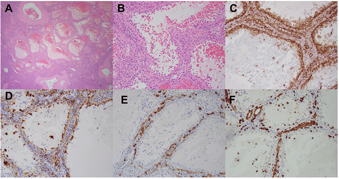 A) Low power image demonstrating proliferation of anastomosing vascular channels. B) High power image demonstrating vascular channels lined by bland endothelial demonstrating a hobnail appearance and with papillary luminal projections. C-F) Immunohistochemical staining for C) CD31, D) CD68, E) CD34, F) and CD8 demonstrate that the cells of the lining are positive for CD31 and CD68, but are negative for CD34 and CD8