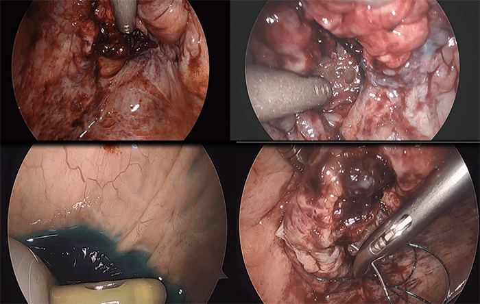 A) During laparoscopic exploration, a clot was found on the intraperitoneal bladder wall, positioned away from the transplant anastomosis. B) Following clot removal, a muscular defect and perforated bladder mucosa were observed. C) A laparoscope was inserted into the bladder to examine the remaining bladder mucosa. D) The bladder defect was closed using an intracorporeal running barbed suture.