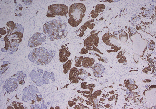 (D) Synaptophysin stain (40x magnification) demonstrating a dual population of tumor cells, highlighting the neuroendocrine component