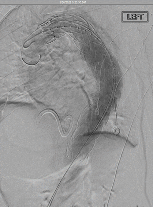 Endovascular deployment of a stent-graft within the descending thoracic aortic aneurysm. The stent-graft extends to the level of the celiac artery. The left subclavian artery remains intentionally uncovered