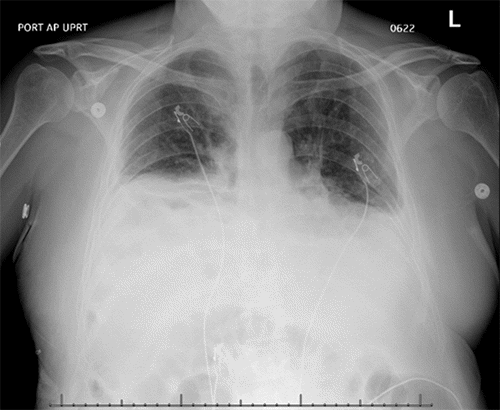 Anteroposterior chest X-ray obtained on POD 4. Note marked elevation of the right hemidiaphragm compared to the immediate postoperative study (Figure 5), raising suspicion for diaphragmatic hernia recurrence or repair failure