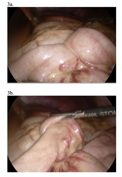 Intraoperative Image  of Small Intestine Intussusception (A) and Subsequent Reduction (B)