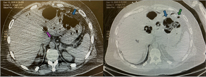 Axial contrast-enhanced CT scan of the abdomen on presentation. The image demonstrates extensive portal venous gas (PVG, purple arrow), gas collections within the left hepatic lobe (blue arrows) consistent with hepatic involvement, and extraluminal free air (pneumoperitoneum, green arrow), collectively indicative of severe emphysematous gastritis with associated complications