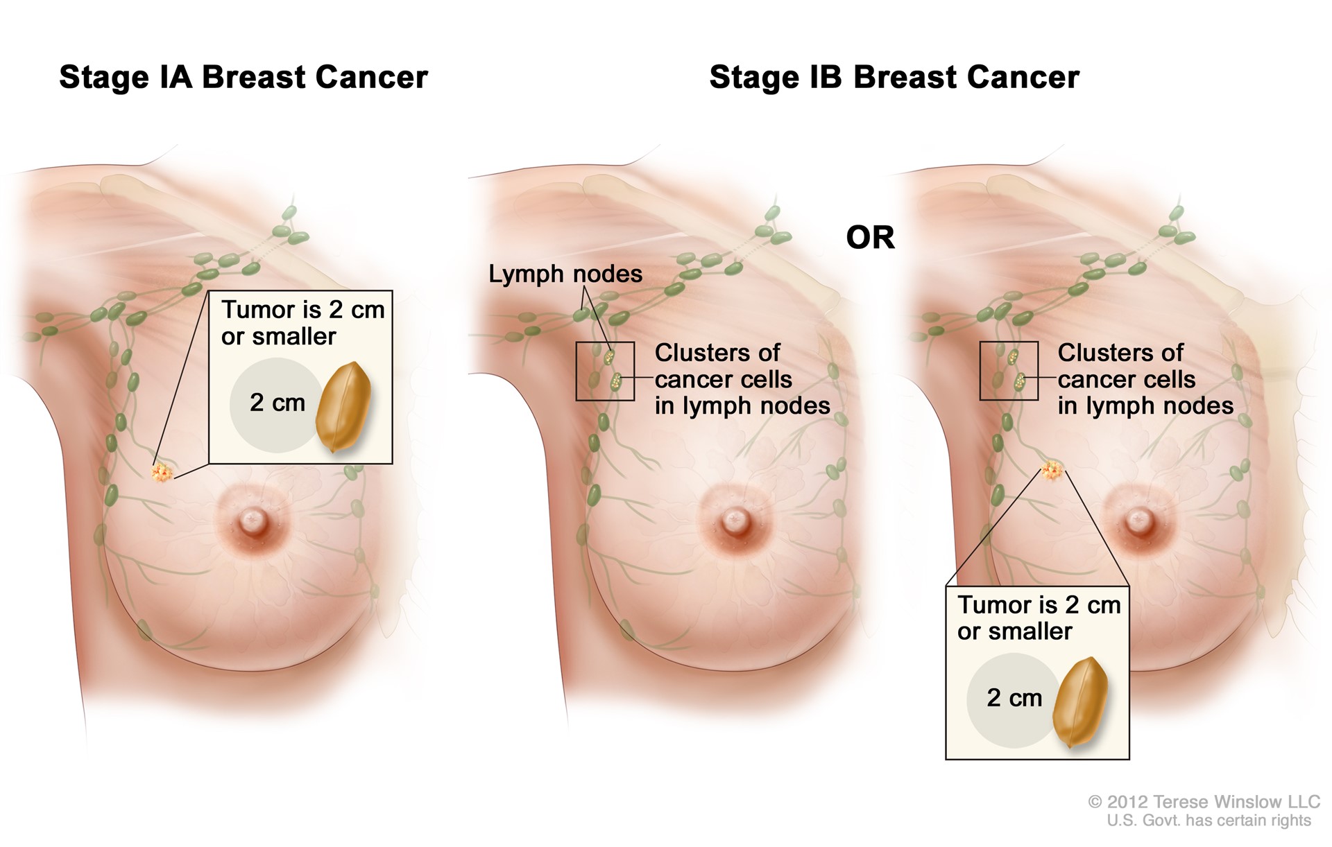 Breast Cancer Staging