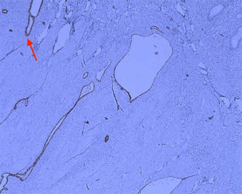 C)  Immunostaining Profile, Demonstrating Endometriosis:  PAX8