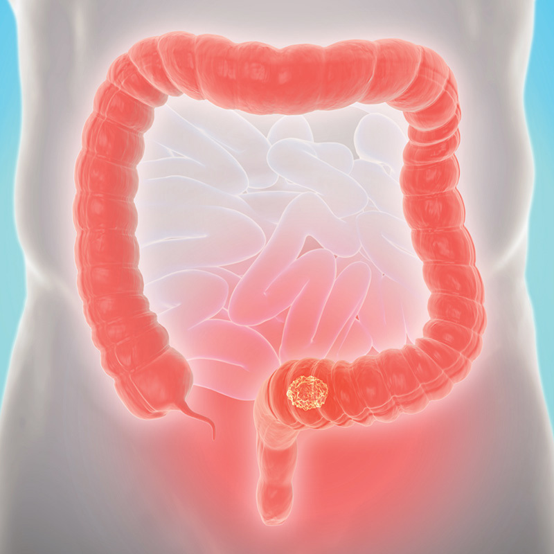 Metastatic Colorectal Cancer is More Advanced in Younger Patients than Older Ones, but They Survive Longer with the Disease, Study Finds 