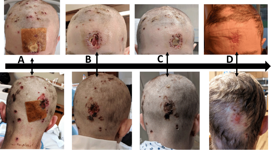 A) Appearance of largest ulcerations the morning after operative debridement: B) 72 hours after initiation of broad-spectrum antibiotic therapy; C) after 48 hours corticosteroid therapy; and D) one month after corticosteroid administration, just before infliximab induction.