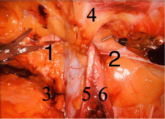 1) direct inguinal hernia; 2) indirect inguinal hernia; 3) femoral space; 4) inferior epigastric vessels; 5) vas deferens; 6) testicular sessel