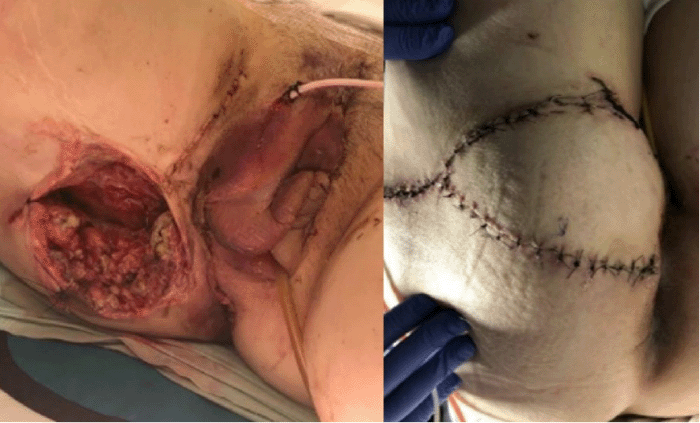 Intraoperative photographs. (Left) The large right lateral perineal soft tissue defect prior to flap coverage. (Right) Appearance after inset of the right IGAP flap, providing robust vascularized tissue coverage