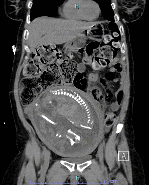 The coronal view confirms significant fecal impaction with multiple air pockets, suggestive of stercoral perforation