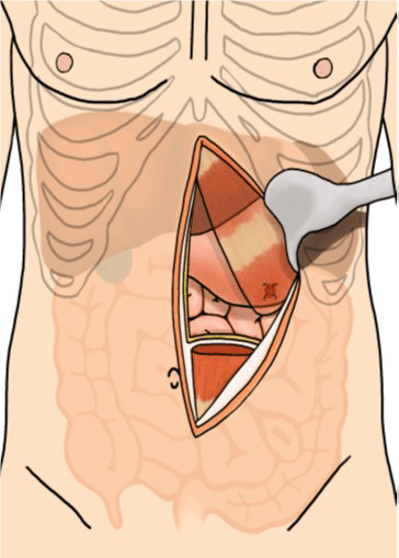 Figure 2. The RAMP flap secured over the gastric perforation.