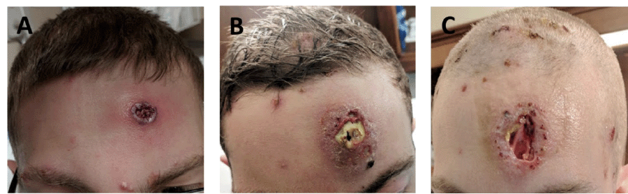 A) Initial appearance of largest ulcerating wound upon initial presentation to emergency department; B) wound appearance 48 hours after initial presentation during doxycycline management; and C) seven days after initial presentation, two days after operative debridement.