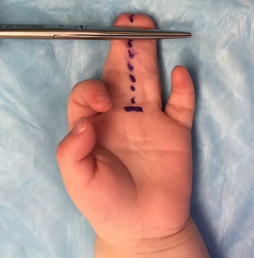 Figure 2. Preoperative picture with surgical markings volar hand.